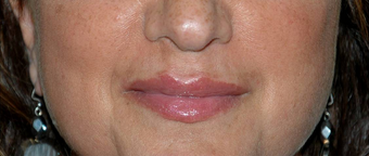 Non-surgical Lip Augmentation for Improved Contour and Definition
