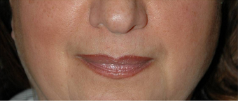 Non-surgical Lip Augmentation for Improved Contour and Definition