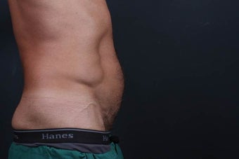 Athletic male who benefited from endoscopic lower abdominal wall tightening.