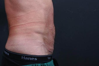 Athletic male who benefited from endoscopic lower abdominal wall tightening.