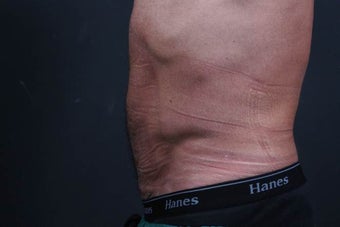 Athletic male who benefited from endoscopic lower abdominal wall tightening.