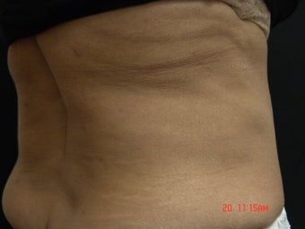 Coolsculpting