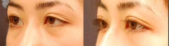 Droopy Eyelid or Ptosis Repair