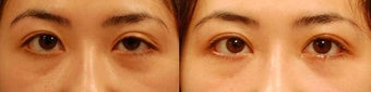 Droopy Eyelid or Ptosis Repair