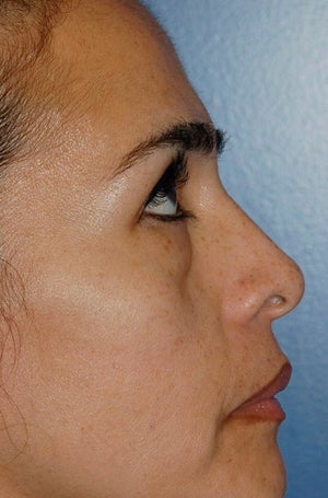 Lower lid blepharoplasty with fat grafting 