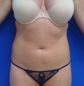 Laser Lipo