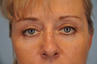 Hetter Peel on lower eyelids. 