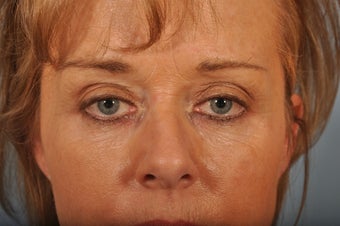 Hetter Peel on lower eyelids. 