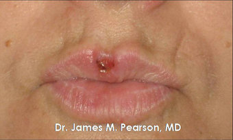 Lip Reconstruction