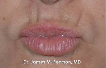 Lip Reconstruction