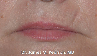 Lip Reconstruction