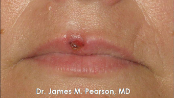 Lip Reconstruction