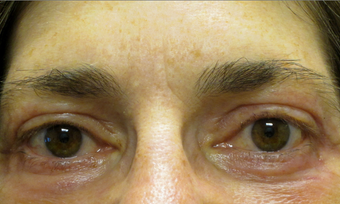 55 year old woman treated for droopy eyelid and eyelid bags