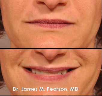 Injectable Filler Treatment