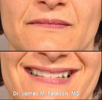 Injectable Filler Treatment
