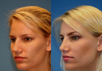 rhinoplasty