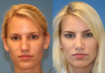 rhinoplasty
