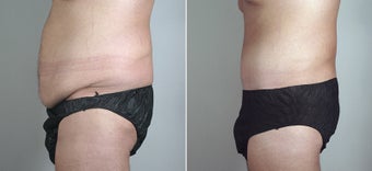 25 year old male with large weight loss had tummy tuck