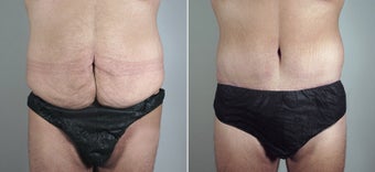 25 year old male with large weight loss had tummy tuck
