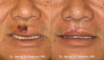 Lip Reconstruction