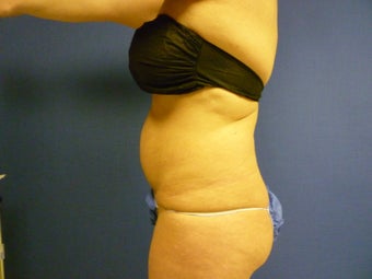 Lipsuction of Abdomen and Waist