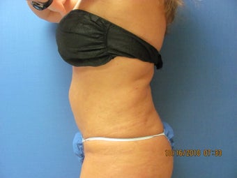 Lipsuction of Abdomen and Waist