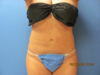 Lipsuction of Abdomen and Waist