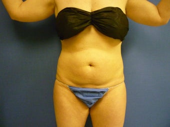 Lipsuction of Abdomen and Waist