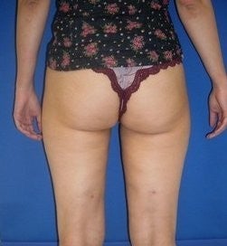 Laser Liposuction