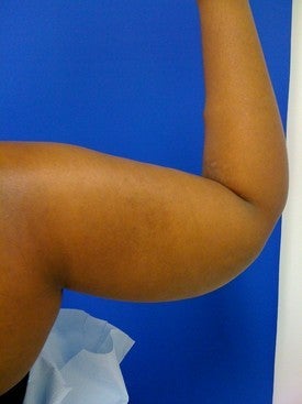 Laser Liposuction