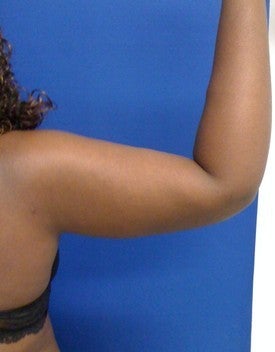 Laser Liposuction