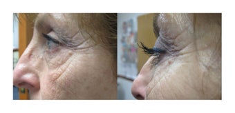 Before and 3 months after Regular Latisse use