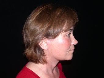 Endoscopic Browlift