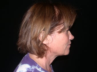 Endoscopic Browlift