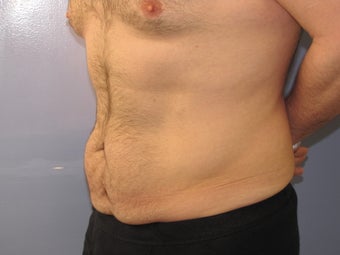 Male Tummy Tuck