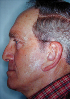 Facelift 
