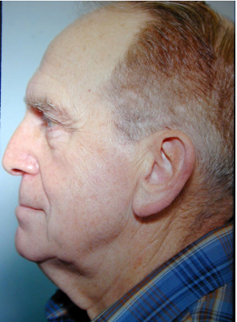 Facelift 