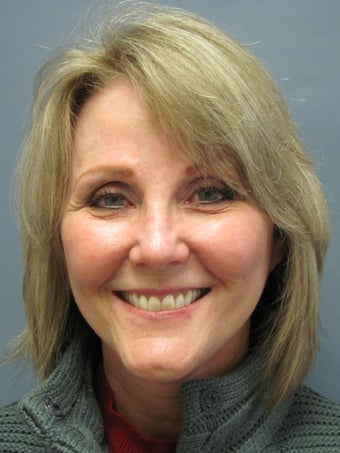 Chin Augmentation