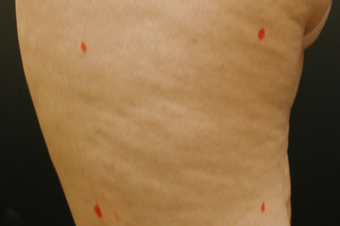 Cellulite Treatment - Cellulaze