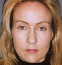 Botox