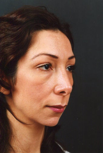 Chin implant elongates the jawline, bringing the face into balance.