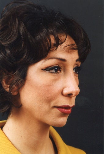 Chin implant elongates the jawline, bringing the face into balance.