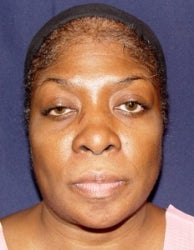 Rhinoplasty Front View