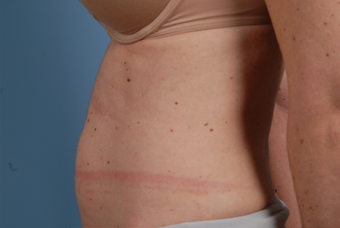 truSculpt