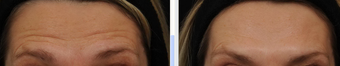 Before and After BOTOX® Cosmetic  - frown lines, forehead lines, crow's feet