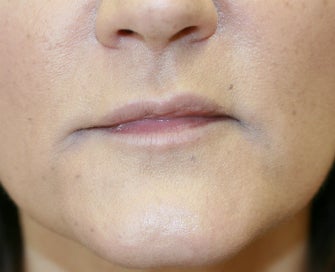 Juvederm into downturned corners of mouth