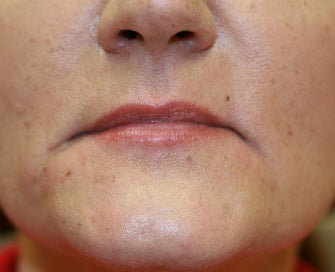 Juvederm into downturned corners of mouth