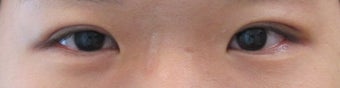 Bilateral Asian Eyelid Surgery