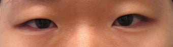 Bilateral Asian Eyelid Surgery