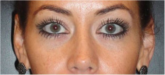 Restylane